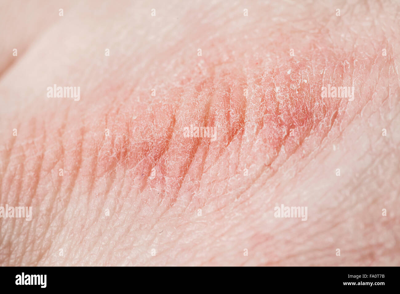 La pelle secca in inverno a portata di mano Foto Stock