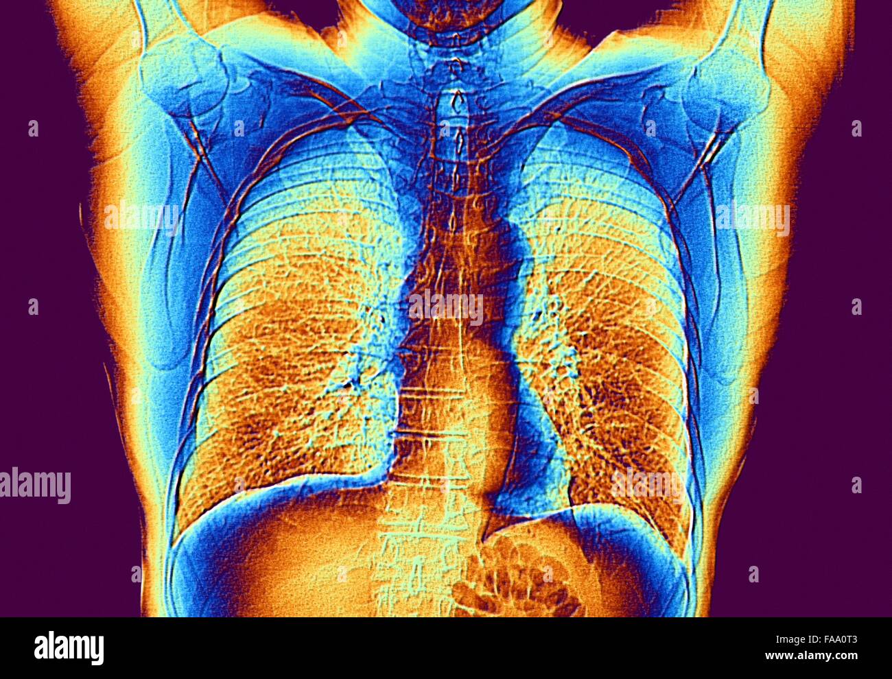 Cuore e polmoni. Falso colore di tomografia computerizzata (CT) Scansione del torace di un adulto sano, che mostra il normale polmoni. Foto Stock