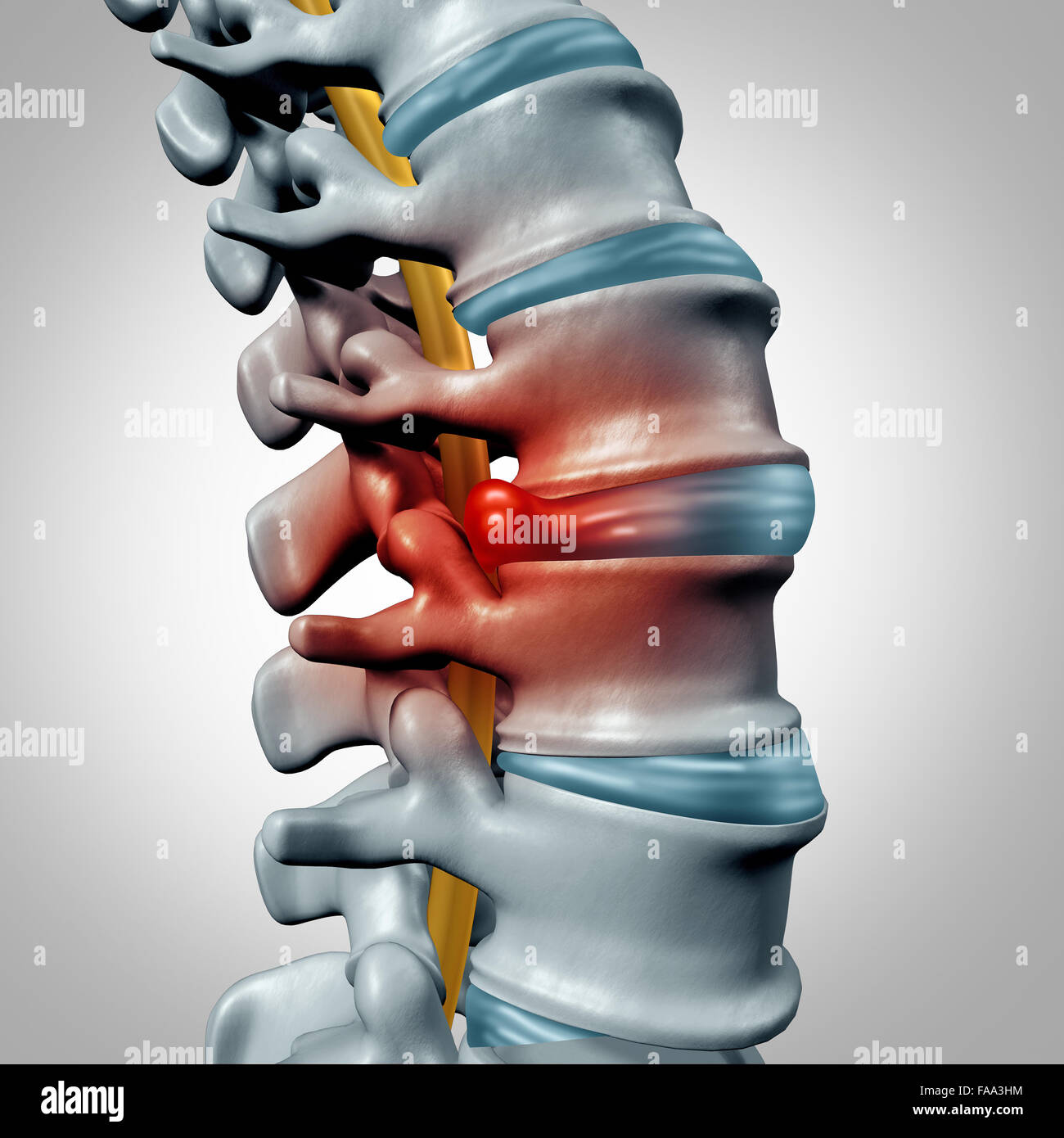Ernia del disco del concetto e il dolore della colonna vertebrale diagnostico come una colonna vertebrale umana simbolo del sistema come medico problema sanitario e simbolo di anatomia con scheletro della struttura ossea e dischi intervertebrali closeup. Foto Stock