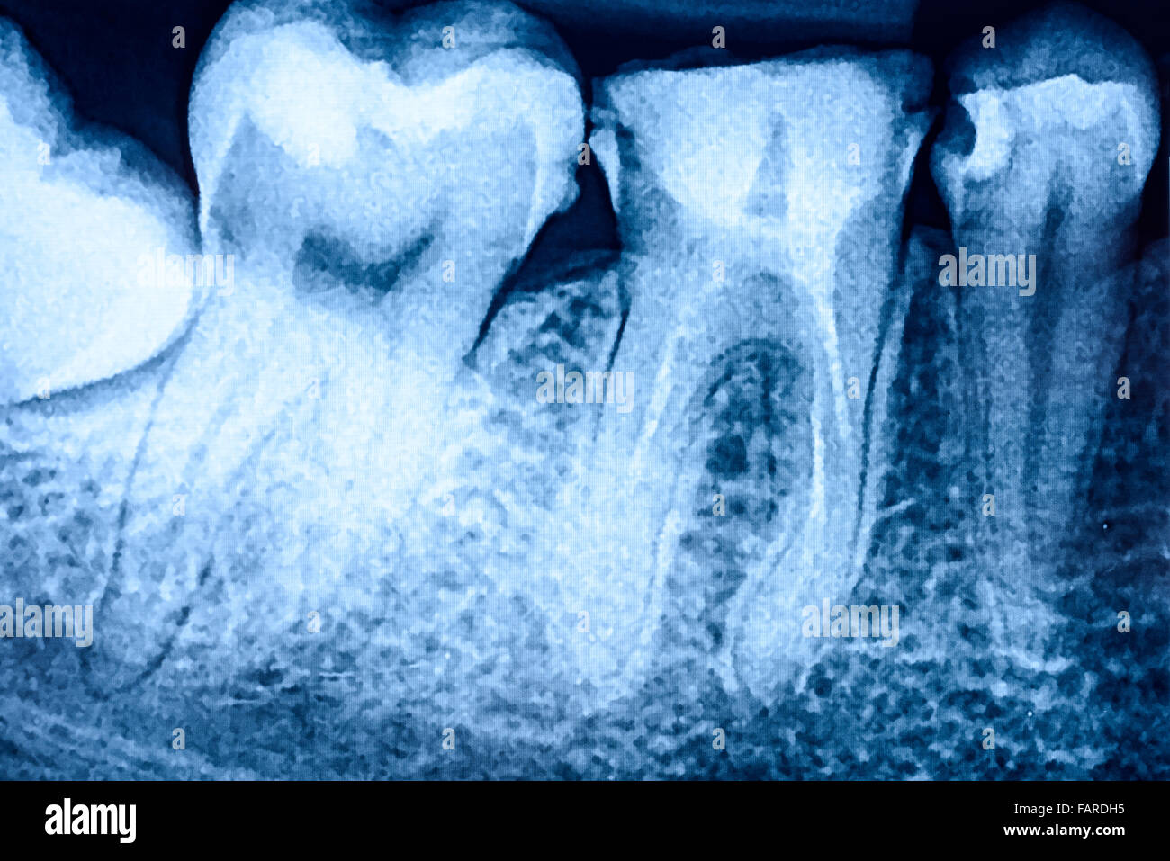 Scleroterapia del canale radicolare sistemi sui denti X-Ray Foto Stock