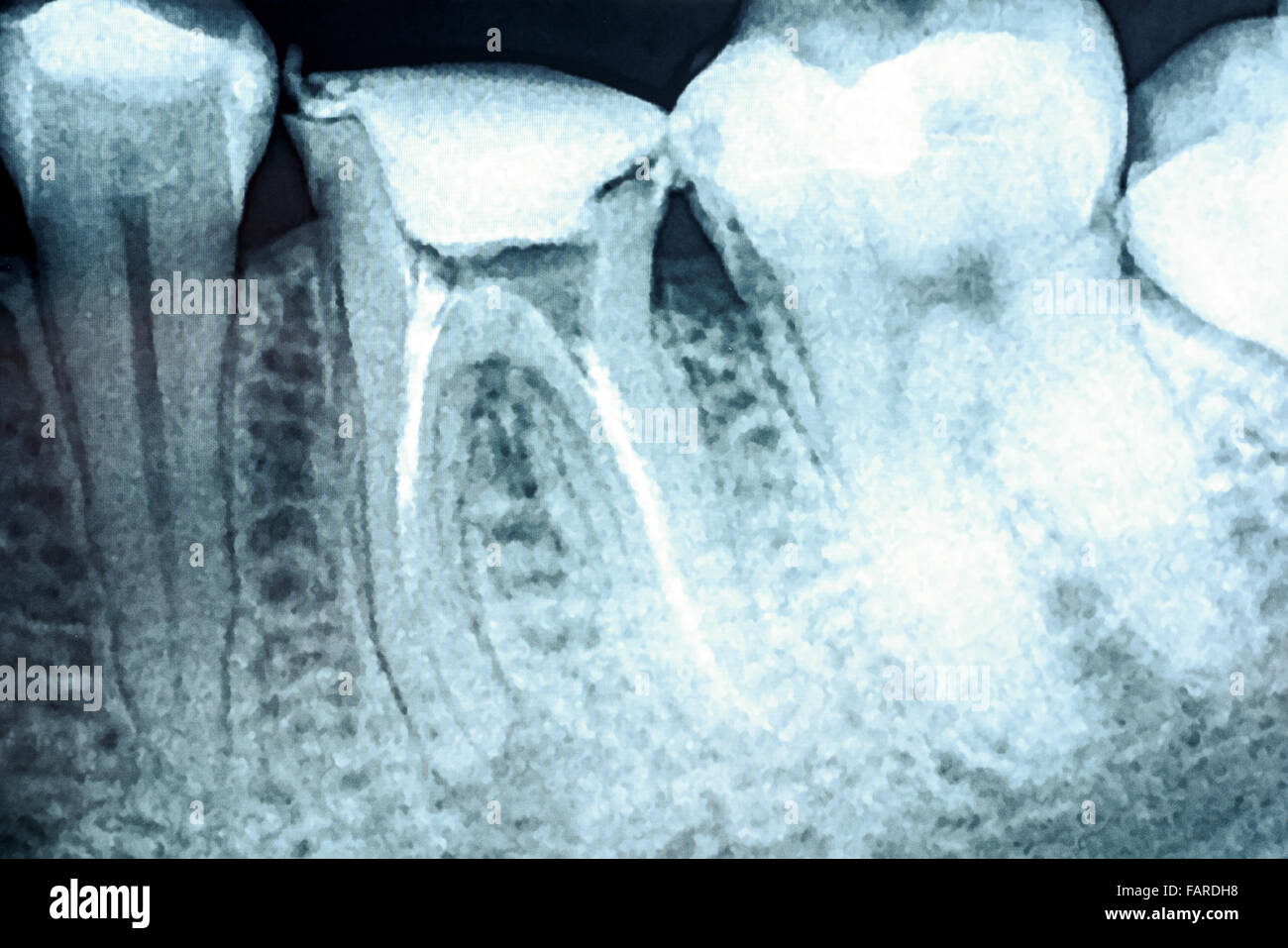 Scleroterapia del canale radicolare sistemi sui denti X-Ray Foto Stock