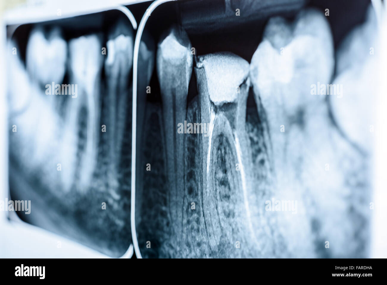 Scleroterapia del canale radicolare sistemi sui denti X-Ray Foto Stock