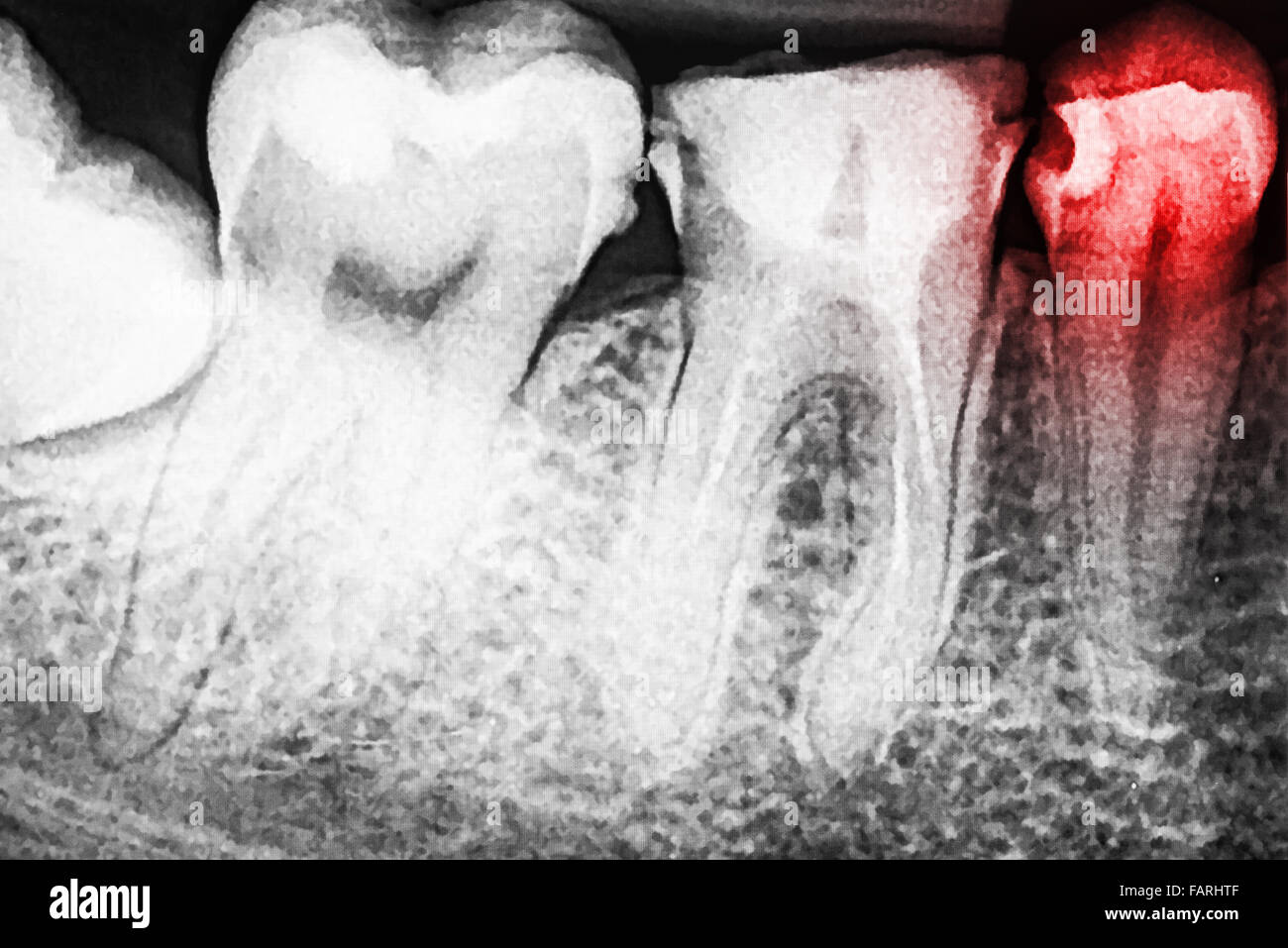 Il dolore di carie sui denti X-Ray Foto Stock