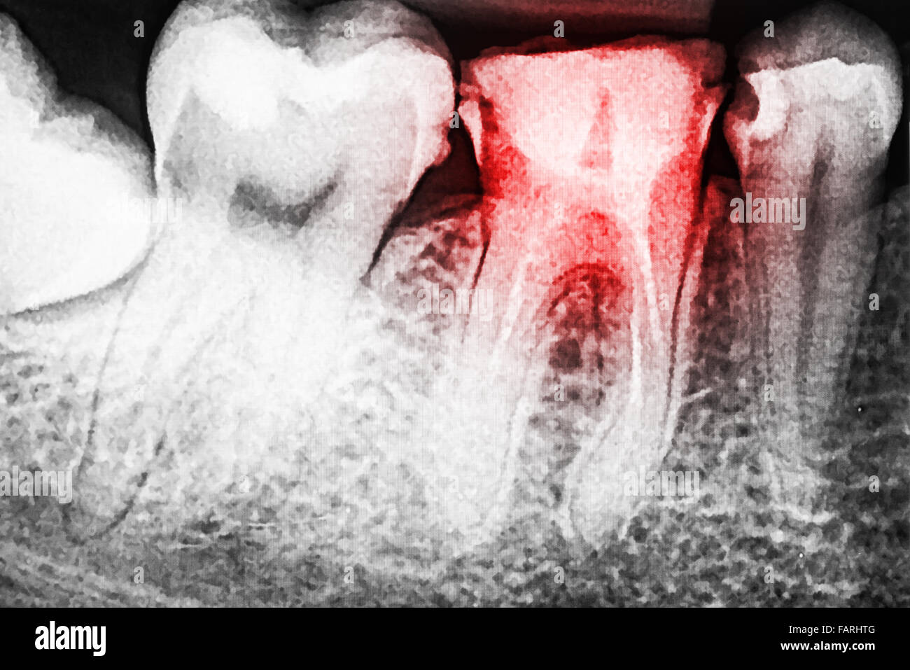 Il dolore di carie sui denti X-Ray Foto Stock