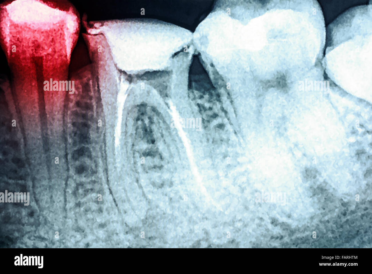 Il dolore di carie sui denti X-Ray Foto Stock