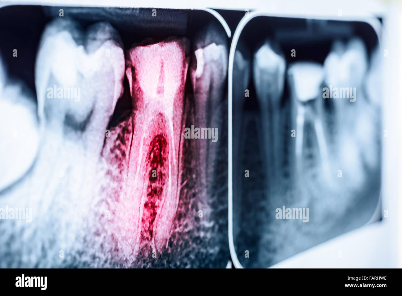 Il dolore di carie sui denti X-Ray Foto Stock