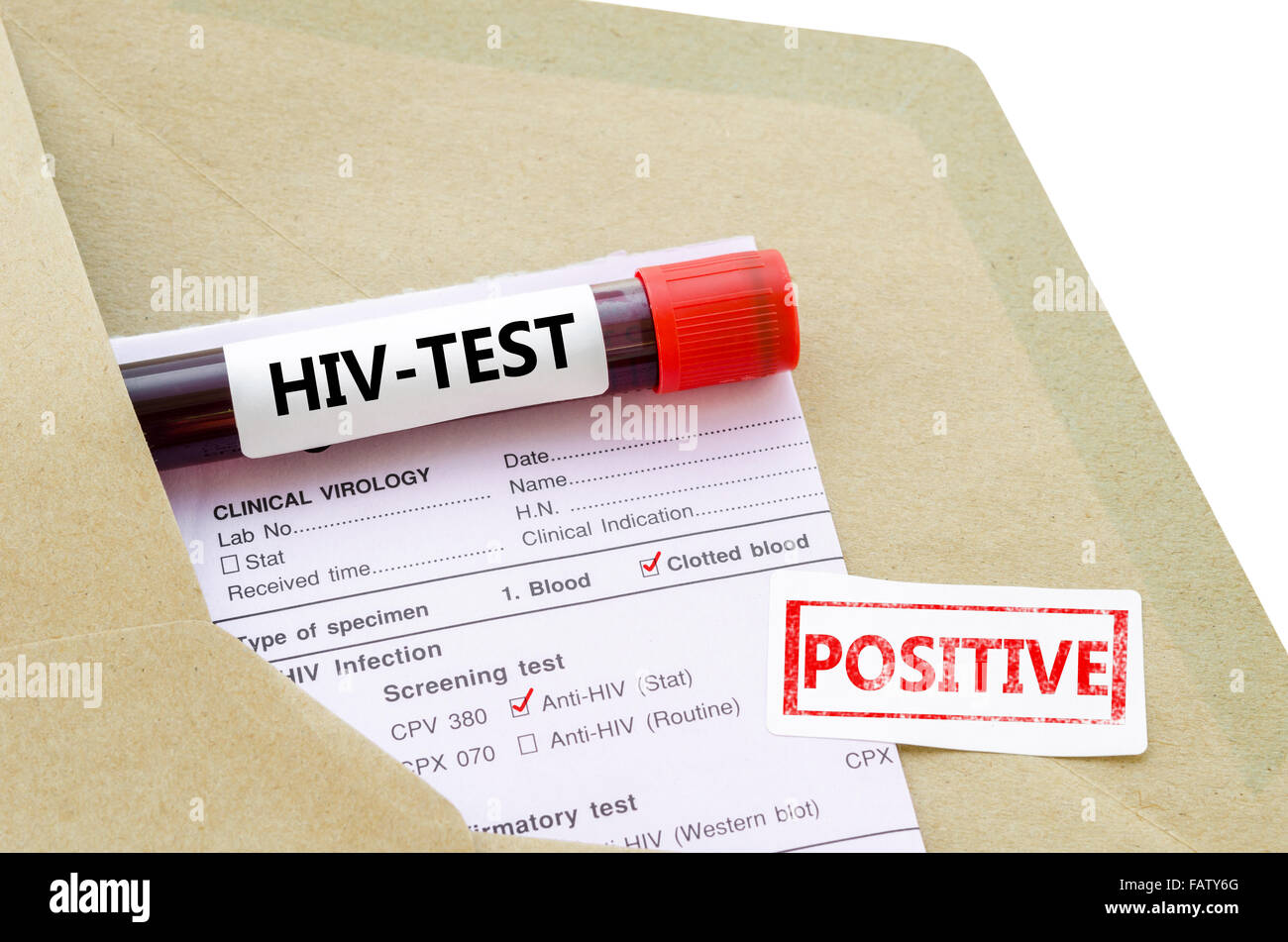 Campione di sangue con test HIV positivo e richiesta modulo di laboratorio su sfondo bianco. Foto Stock