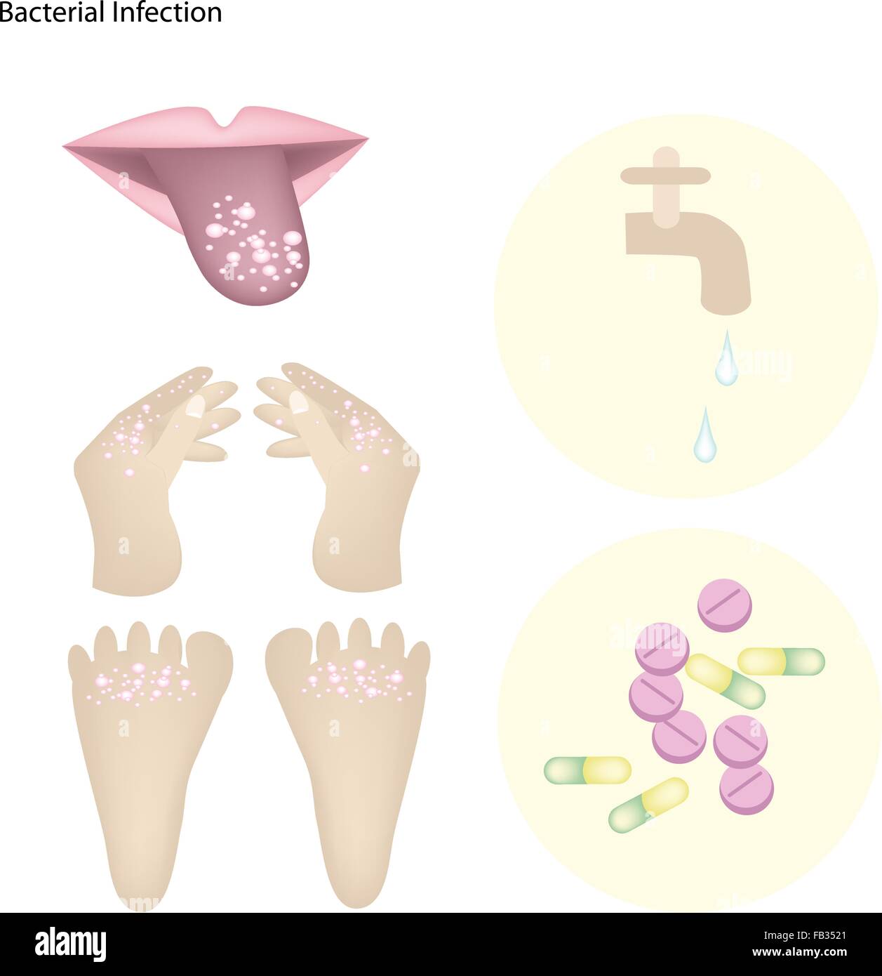 Concetto medico, illustrazione di infezione batterica, bocca, Palm e piedi con parte del processo di trattamento. Illustrazione Vettoriale