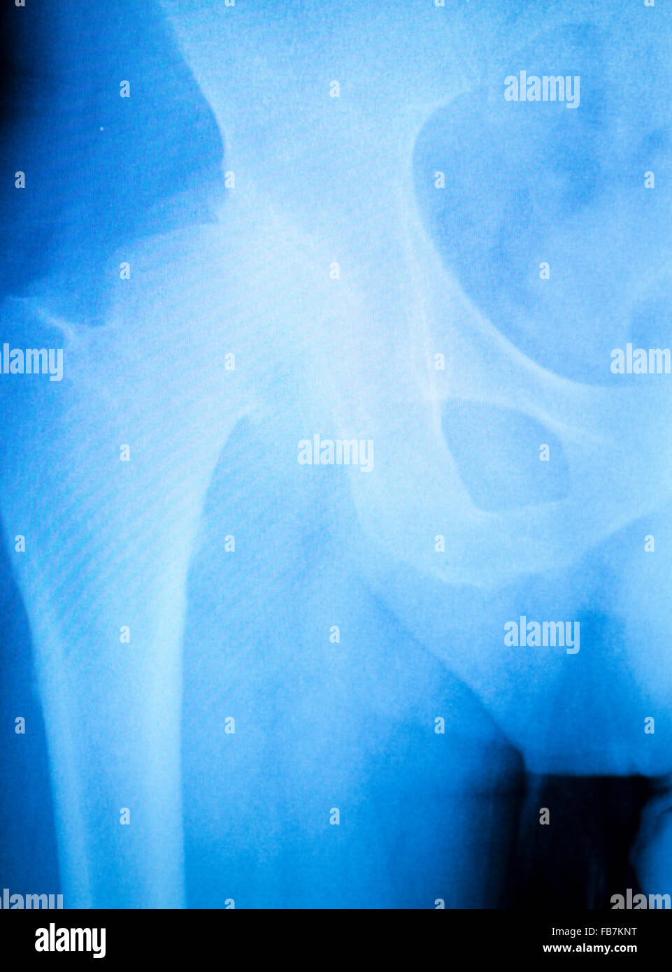 Anca artritiche xray scansione di prova ortopedia e traumatologia risultati. Foto Stock
