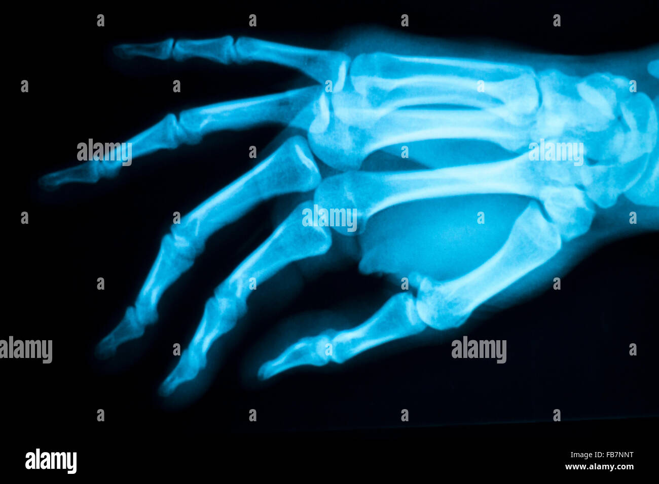 Mano, le dita e il pollice ospedale scansione a raggi x i risultati dei test per i dolori articolari e lesioni in medicina ortopedica e traumatologia clinica. Foto Stock