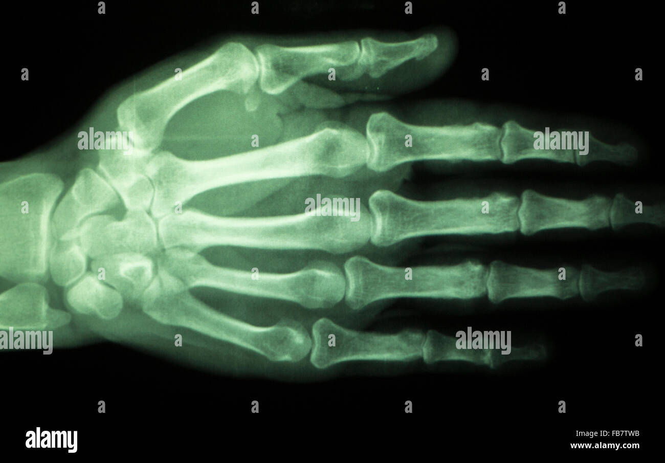 Mano, le dita e il pollice ospedale scansione a raggi x i risultati dei test per i dolori articolari e lesioni in medicina ortopedica e traumatologia clinica. Foto Stock