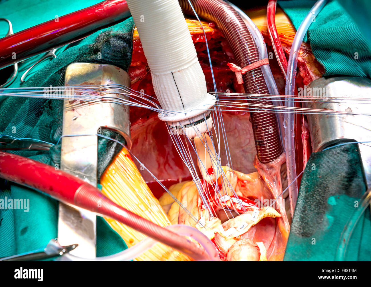 Cuciture poste attraverso un composito di innesto durante l'aneurisma aortico chirurgia Foto Stock