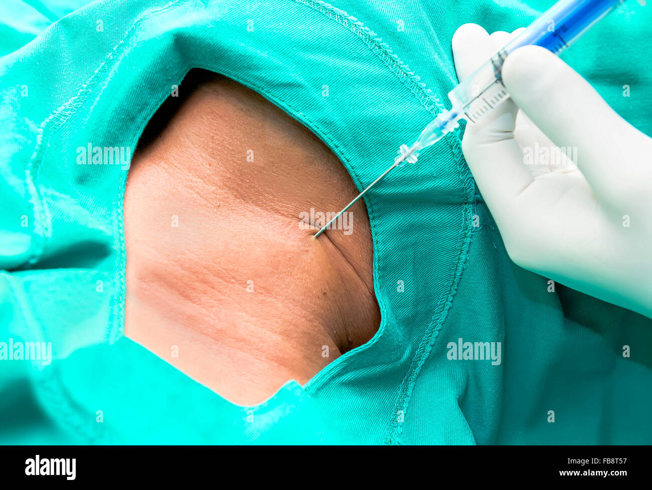 Il posizionamento di un catetere venoso centrale Foto Stock