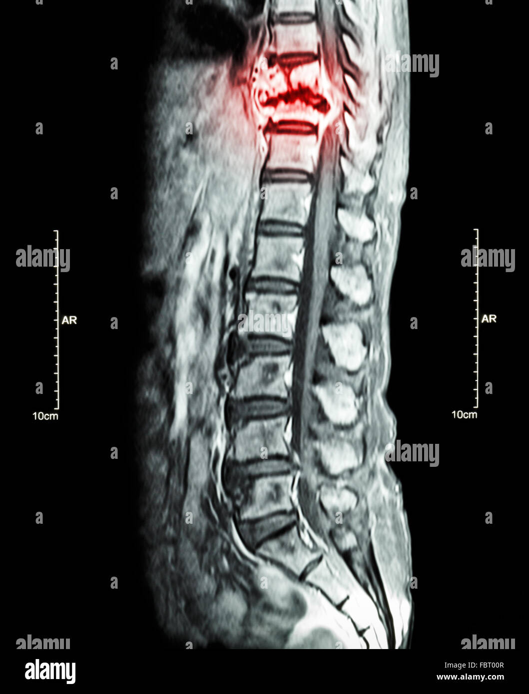 La colonna vertebrale metastasi ( la diffusione del cancro alla colonna vertebrale toracica ) ( MRI della colonna toracica e lombare : Mostra colonna toracica metastasi e com Foto Stock