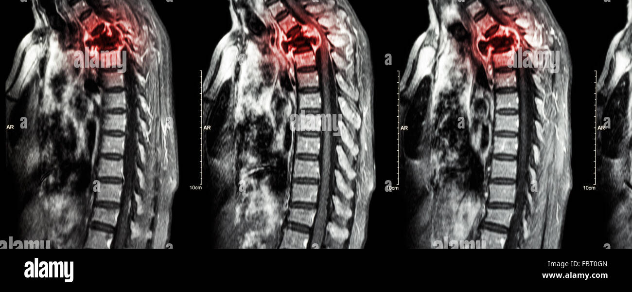 La colonna vertebrale metastasi ( la diffusione del cancro alla colonna vertebrale toracica ) ( MRI della colonna vertebrale cervicale e toracica : Mostra colonna toracica metastasi e c Foto Stock