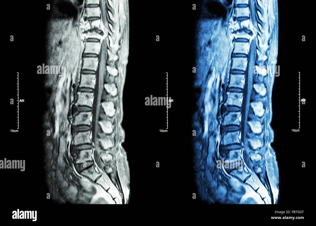 La colonna vertebrale metastasi ( la diffusione del cancro alla colonna vertebrale toracica ) ( MRI della colonna toracica e lombare : Mostra colonna toracica metastasi e com Foto Stock