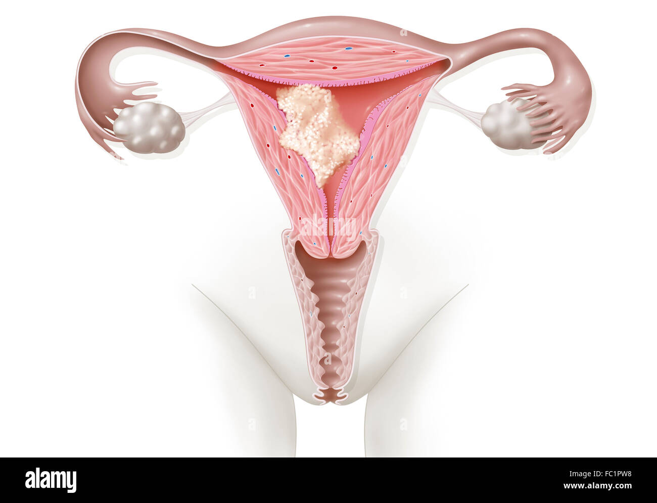 Cancro endometriale, disegno Foto Stock