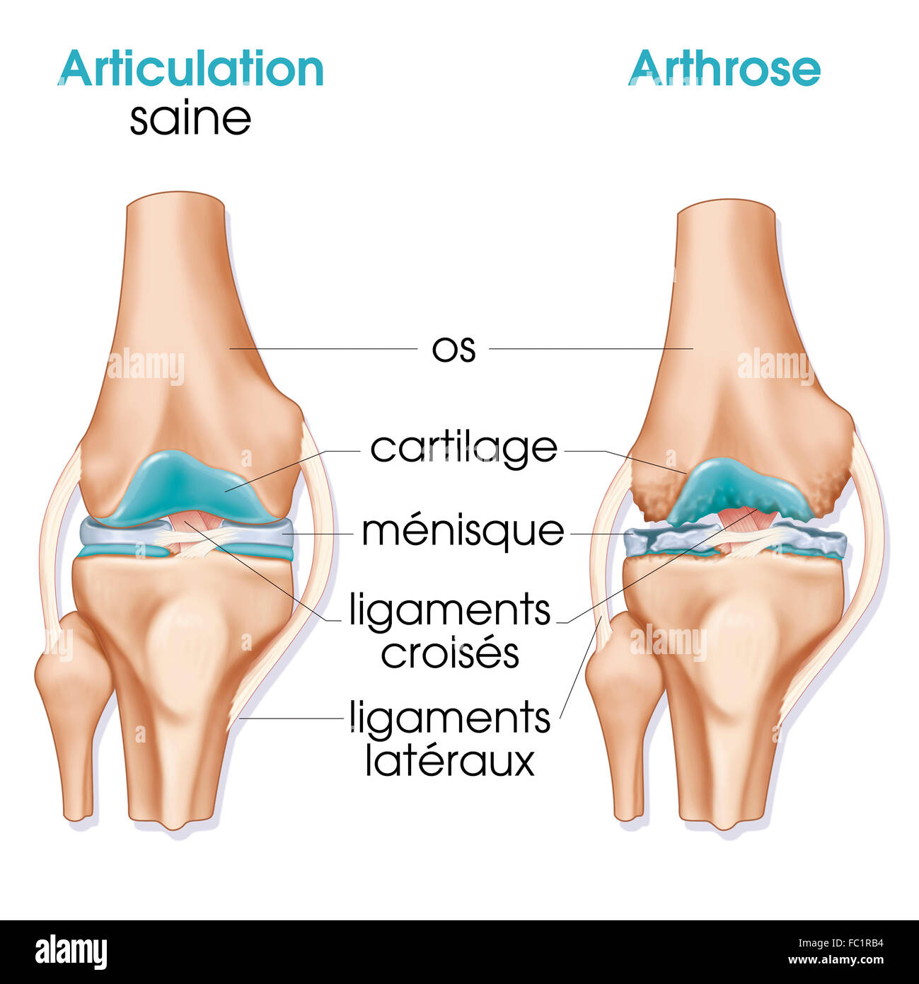 Osteoartrite, illustrazione Foto Stock