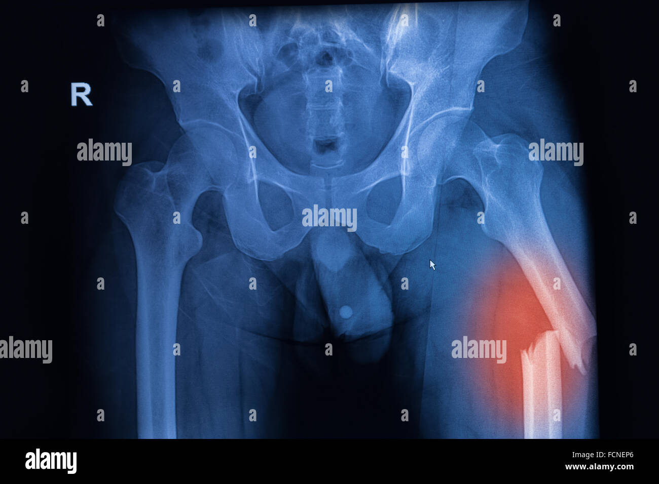 Immagine a raggi X di sia alla moda che mostra la frattura del femore al lato sinistro Foto Stock