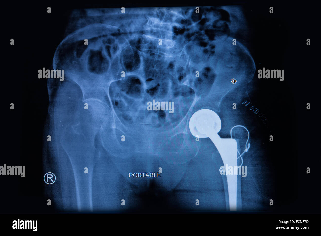 X-ray di endoprotesi d'anca nella donna anziana, totale sostituzione dell'anca Foto Stock