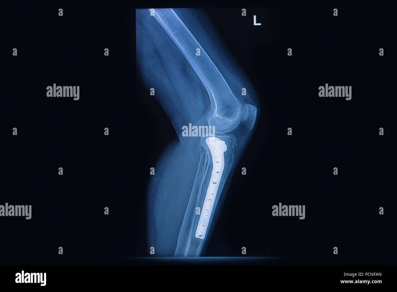 X-ray di frattura della tibia della gamba(ossa). osso tibiale con interni fissati dalla piastra&vite Foto Stock