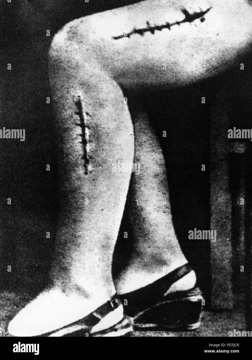 La mutilazione su una vittima di un esperimento di Ravensbrueck campo di concentramento Foto Stock