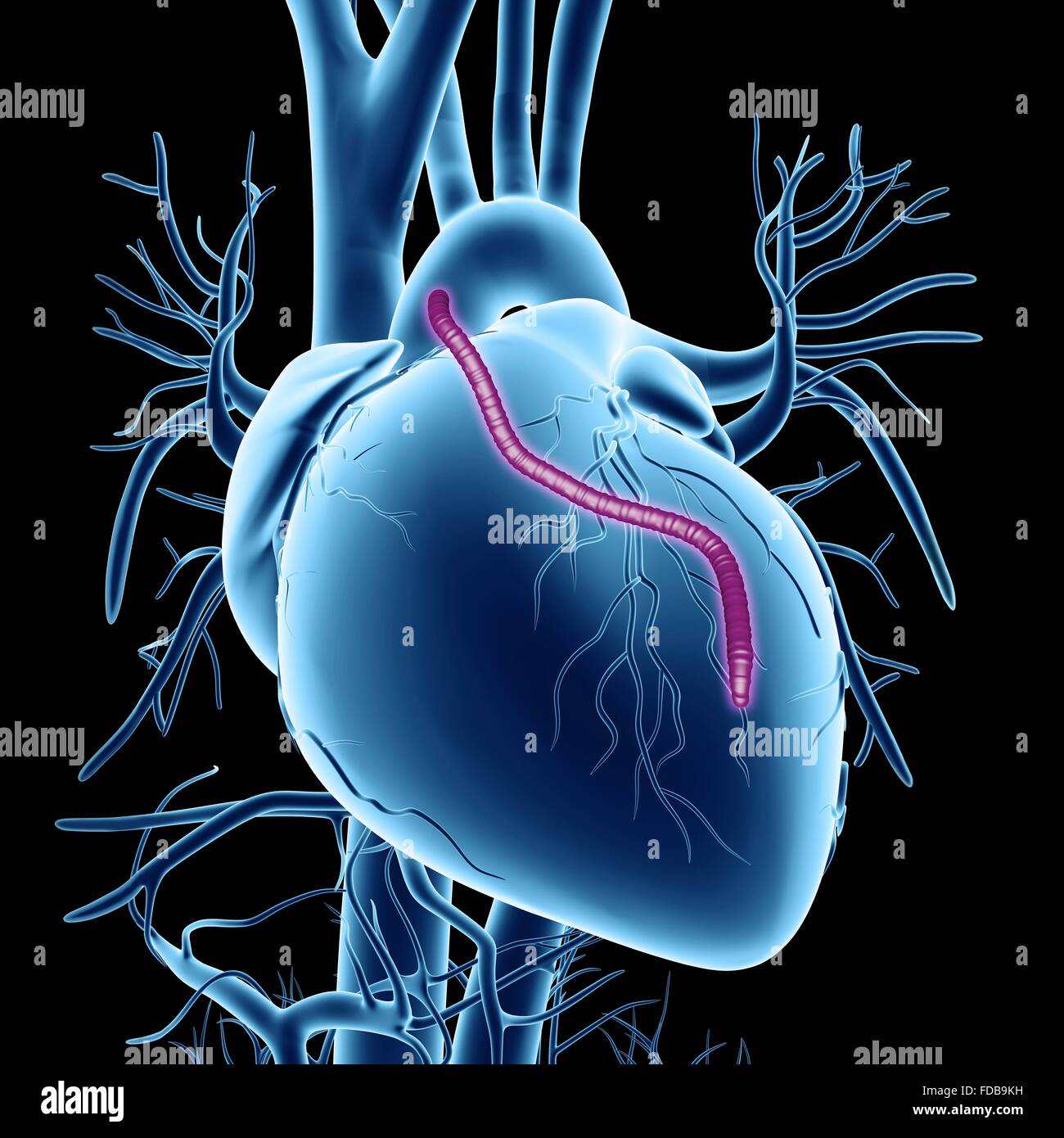 Cuore di innesto di bypass. Computer grafica di un cuore che ha avuto un blocco delle arterie coronarie trattati mediante innesto di bypass nell'arteria coronarica (CABG) chirurgia. Le arterie coronariche sono i piccoli vasi sanguigni visto correre oltre la superficie esterna del cuore. Essi forniscono sangue ossigenato per mantenere il muscolo cardiaco, di pompaggio e di un blocco può causare un attacco di cuore mortale. La soluzione è raccolto dalle arterie altrove nel corpo e li utilizzano per bypassare il blocco. Un innesto è visto correre dall'aorta, il corpo principale arteria, torna a le arterie coronarie. Foto Stock