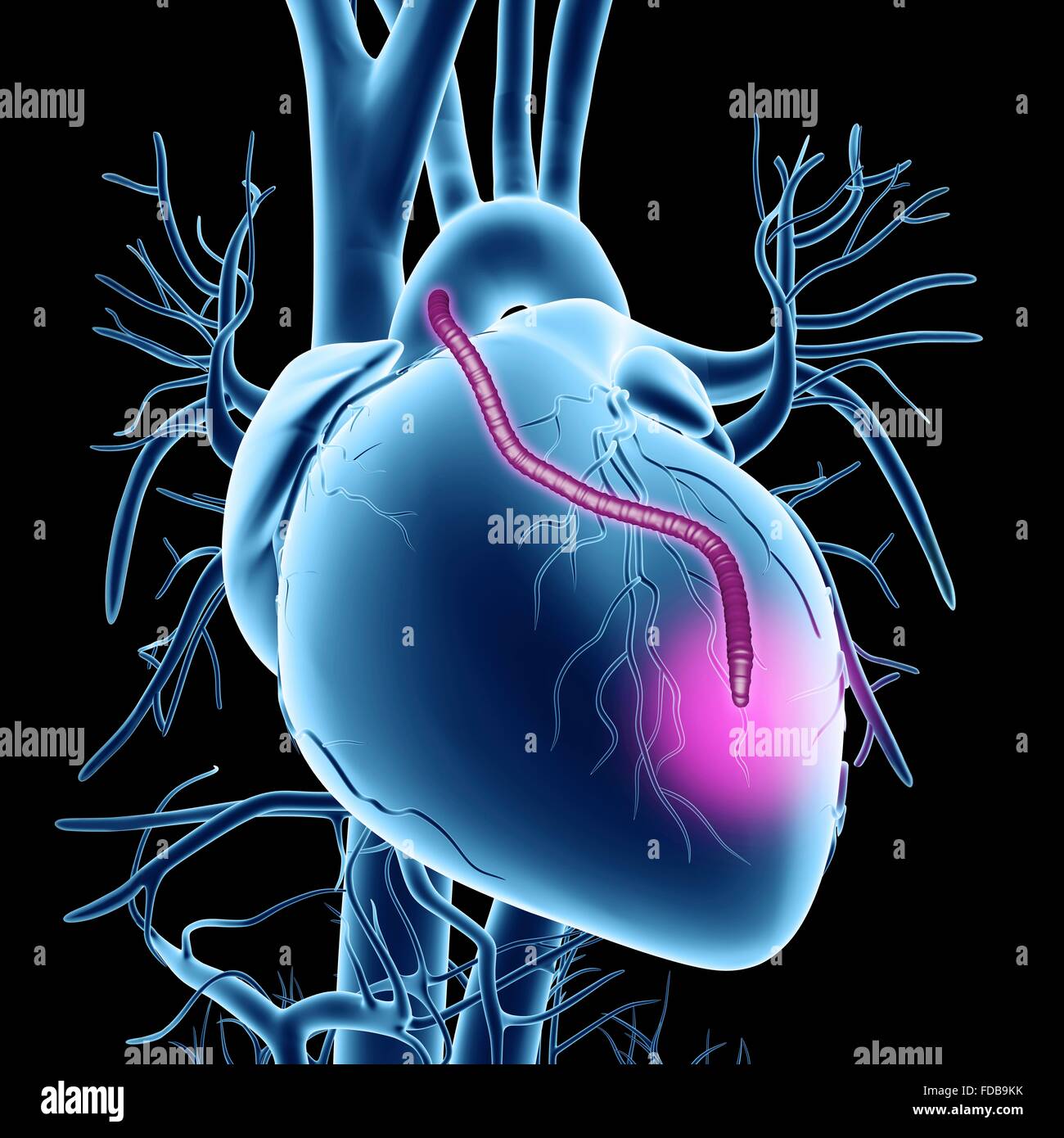 Cuore di innesto di bypass. Computer grafica di un cuore che ha avuto un blocco delle arterie coronarie trattati mediante innesto di bypass nell'arteria coronarica (CABG) chirurgia. Le arterie coronariche sono i piccoli vasi sanguigni visto correre oltre la superficie esterna del cuore. Essi forniscono sangue ossigenato per mantenere il muscolo cardiaco, di pompaggio e di un blocco può causare un attacco di cuore mortale. La soluzione è raccolto dalle arterie altrove nel corpo e li utilizzano per bypassare il blocco. Un innesto è visto correre dall'aorta, il corpo principale arteria, torna a le arterie coronarie. Foto Stock