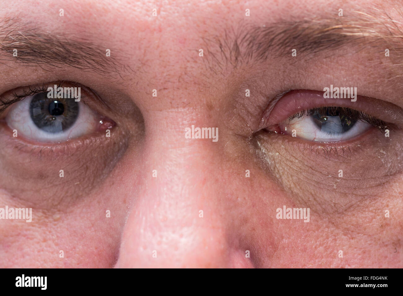 Close up di infezione degli occhi con palpebre gonfie Foto stock - Alamy