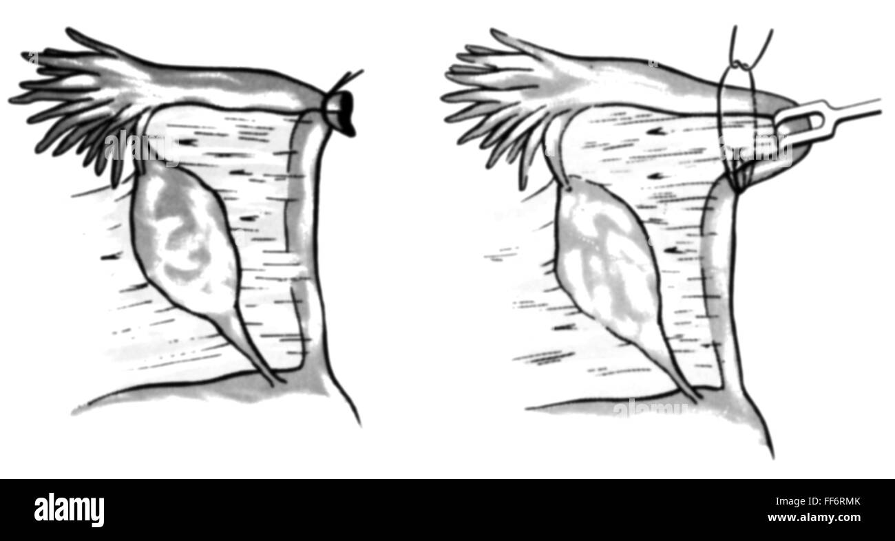 Medicina, funzionamento, sterilizzazione, legatura tubiale, schema, disegno, grafico, grafica, schema, schema, schemi, interventi, interventi chirurgici, interventi chirurgici, ovidotto, tubo di Falloppio, ligato, ligazione, ginecologia, ginecologia, contraccezione, pianificazione familiare, ovvia, medicina, farmaci, funzionamento, interventi, sterilizzazione, sterilizzazione, disegno, disegno, storico, storico, diritti aggiuntivi non disponibili Foto Stock