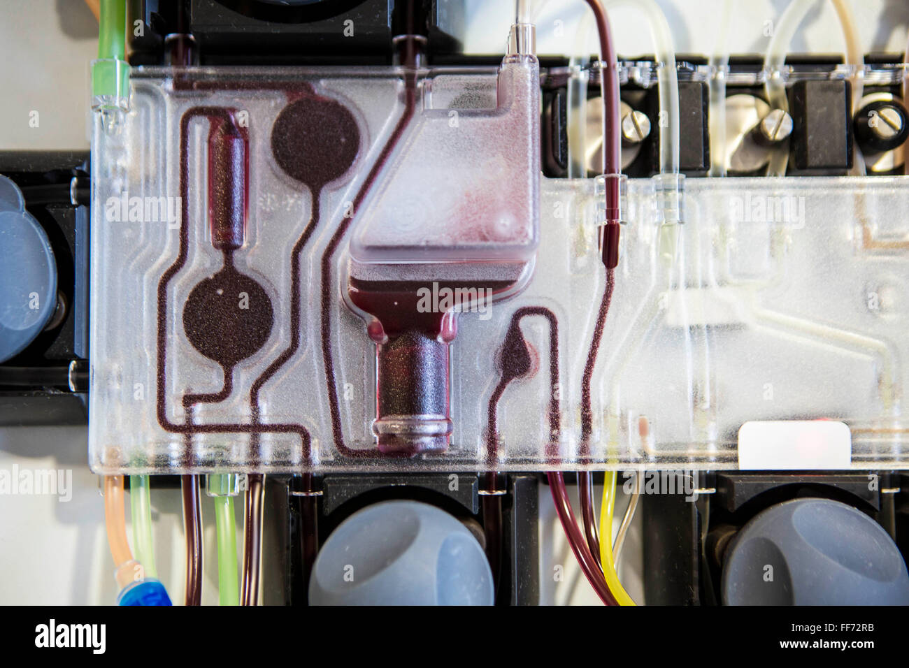 Trasfusione medica attrezzature, chiamato un separatore cellulare, che raccoglie il sangue umano e lo separa per raccogliere le cellule staminali e restituisce il resto del sangue al paziente in clinica londinese, Londra, Regno Unito. Le cellule staminali ematopoietiche verrà quindi utilizzato come un trapianto allogenico per una persona indipendente che ha il cancro del sangue (leucemia linfoma, mieloma). Foto Stock