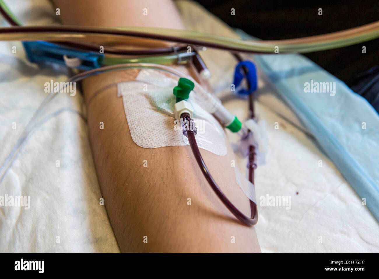 Una cannula collocato in un braccio del paziente per la raccolta di sangue per una cellula staminale di trasfusione di donazione in clinica londinese, Londra, Regno Unito. Una volta che le cellule staminali sono state separate, il sangue è di ritorno al paziente attraverso il loro braccio. Foto Stock