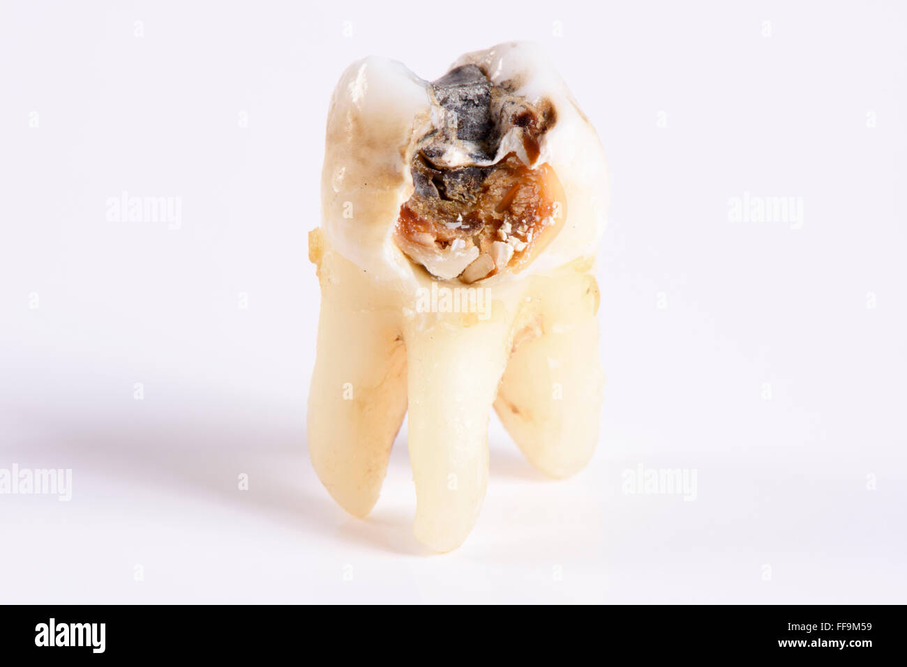 Estratto il dente molare con massiccia la carie Foto Stock