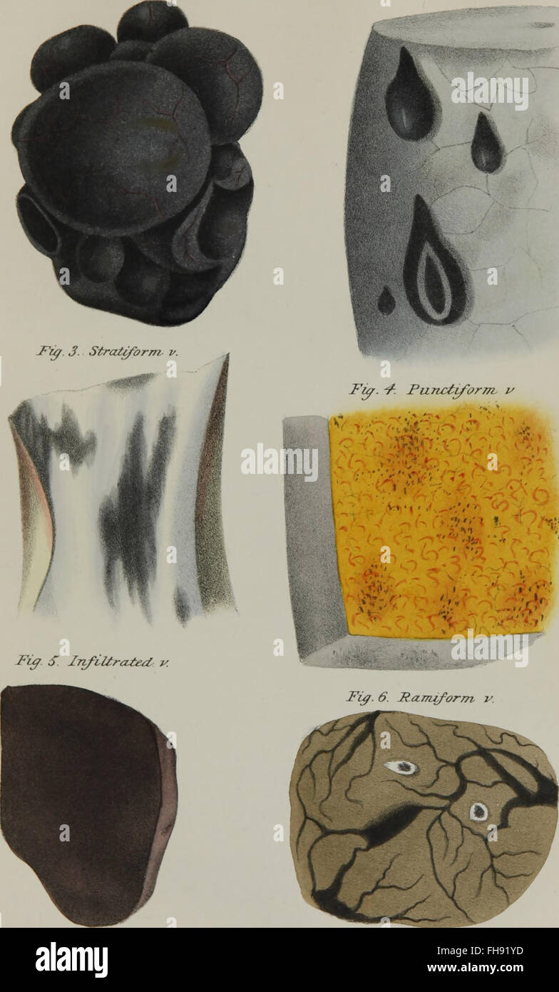 Un lavoro medico del 1845 incentrato sullo studio dell'anatomia patologica, che descrive i cambiamenti strutturali nei tessuti e negli organi dovuti a malattie. Foto Stock