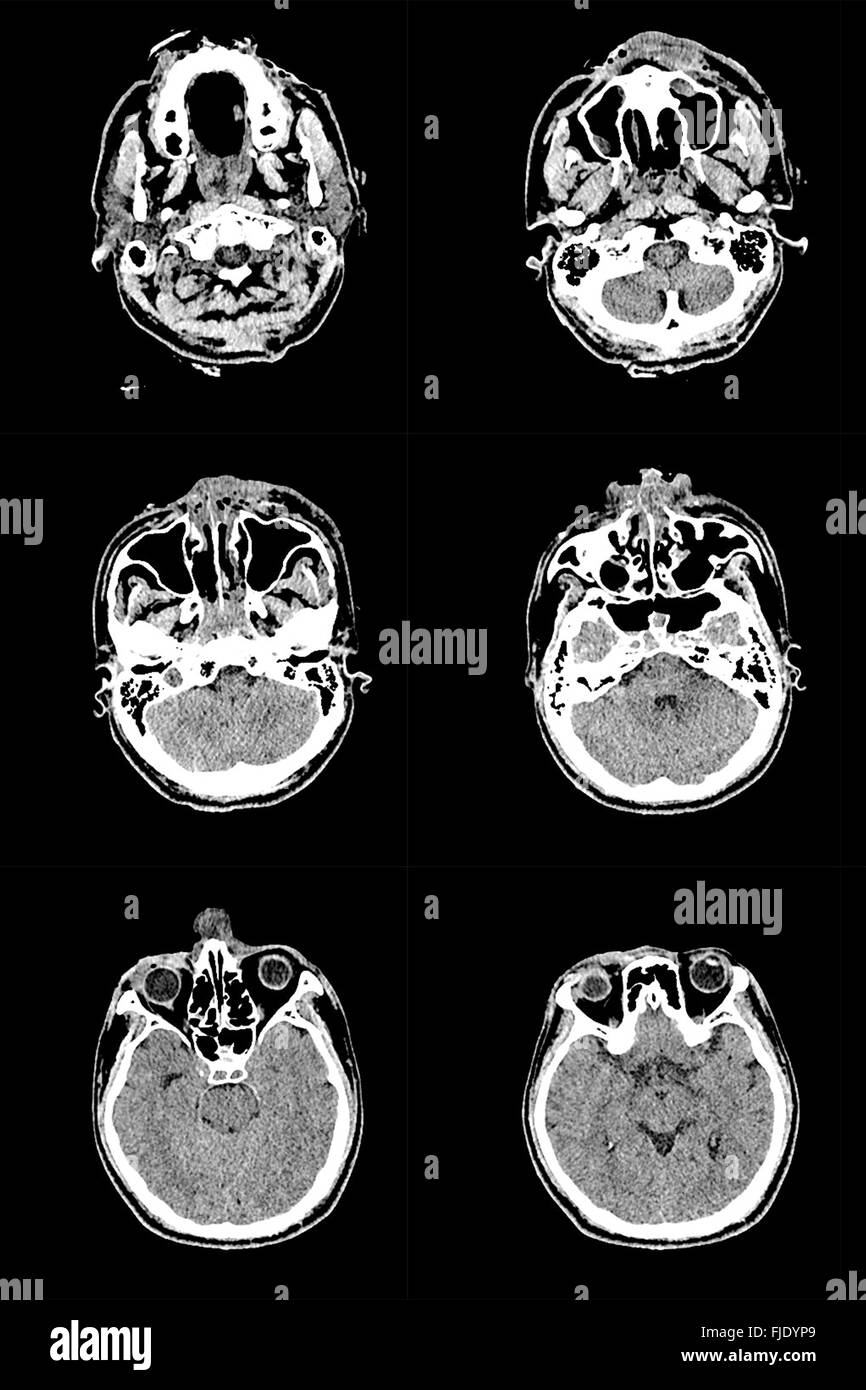 Ricerca in medicina. Scansione CT del paziente. Foto Stock