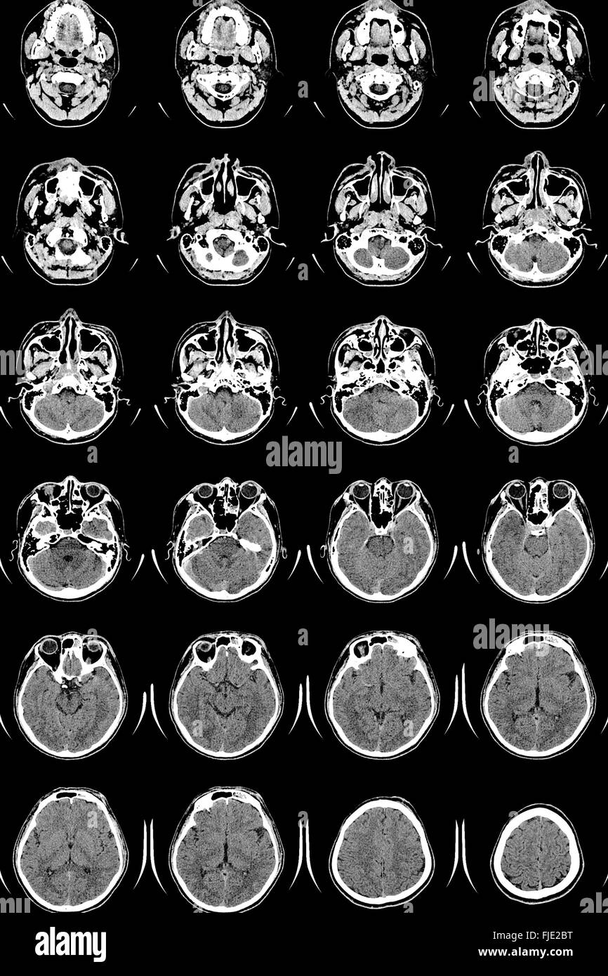 Ricerca in medicina. Scansione CT del paziente. Foto Stock