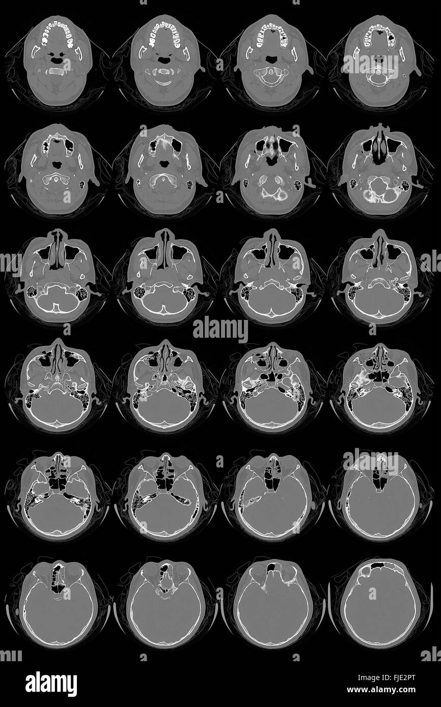 Ricerca in medicina. Scansione CT del paziente. Foto Stock