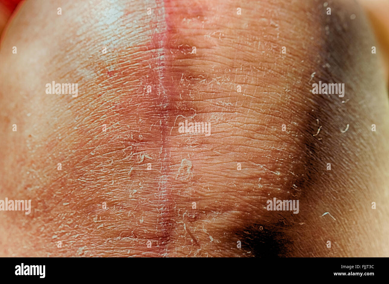 Cicatrici della persona vecchia gambe che avevano subito un ginocchio le operazioni di sostituzione Foto Stock