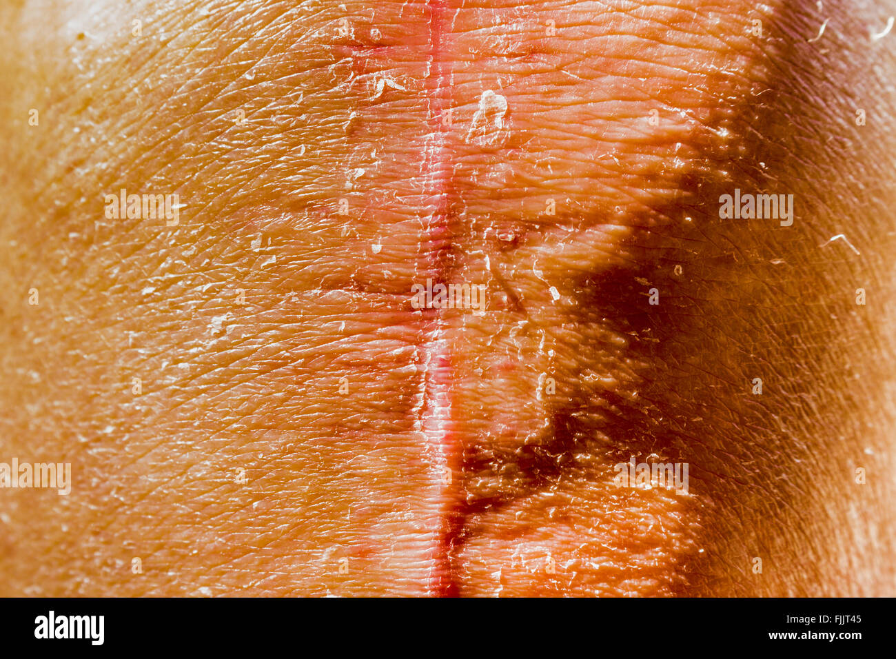 Cicatrici della persona vecchia gambe che avevano subito un ginocchio le operazioni di sostituzione Foto Stock