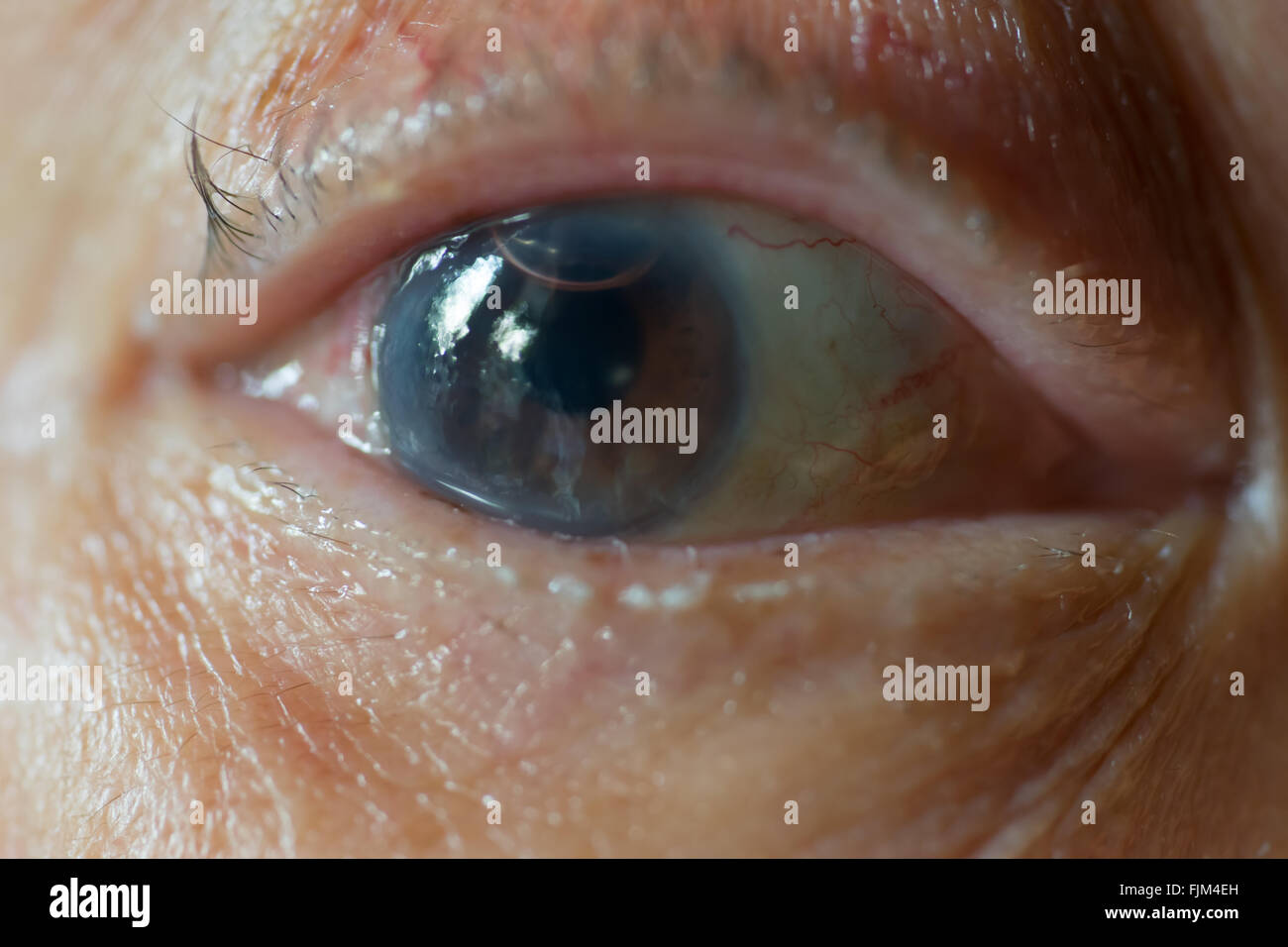 Il vecchio uomo di occhio con traccia di cornea operazione chirurgica e bolla di aria Foto Stock