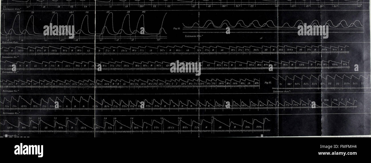 "Aritmia of the Heart" (1904) è uno studio clinico che esplora i meccanismi fisiologici e le implicazioni cliniche delle aritmie cardiache. Fornisce informazioni sulla salute del cuore e la comprensione medica dei ritmi cardiaci anomali. Foto Stock