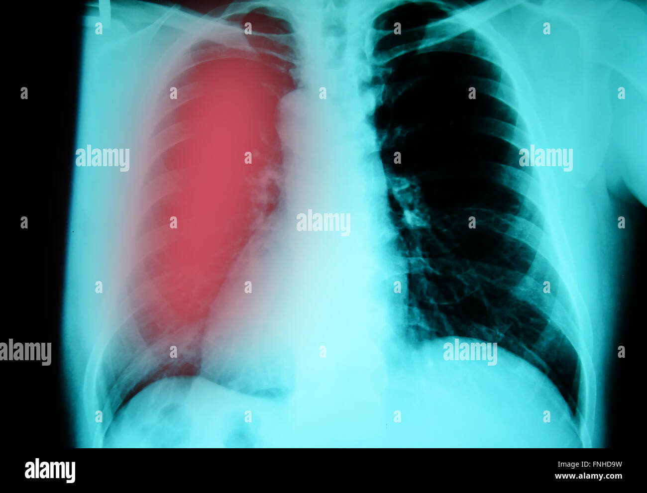 Petto di un esame a raggi x per la diagnosi La tubercolosi polmonare infezione Foto Stock