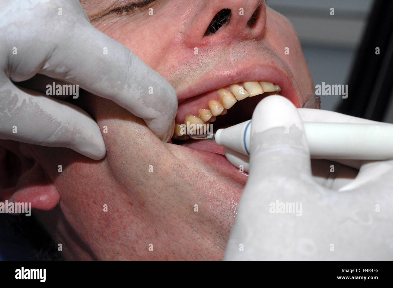 Un dentista rimozione della placca e del tartaro da un uomo di denti per evitare di cavità e altri problemi peridontal Foto Stock