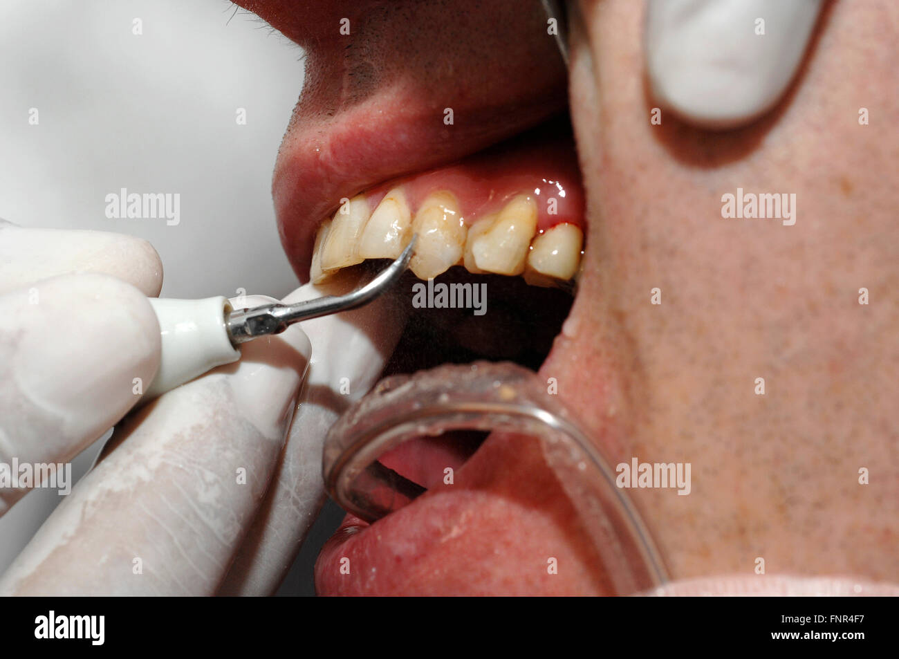 Denti tartaro immagini e fotografie stock ad alta risoluzione - Alamy