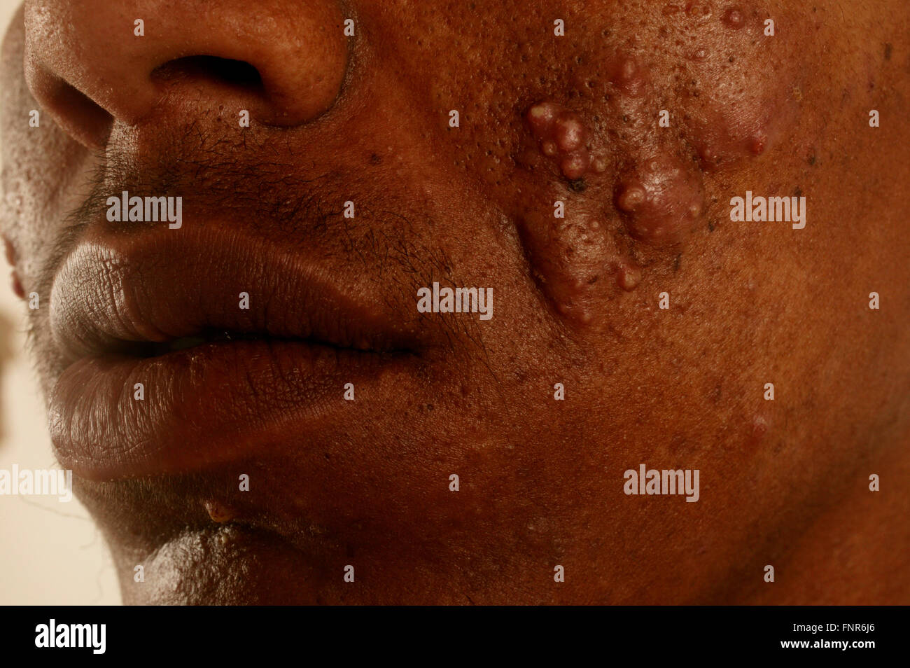 In prossimità della metà inferiore della faccia di un ventunenne maschi affetti da acne vulgaris. L'acne vulgaris è un disturbo della pelle Foto Stock