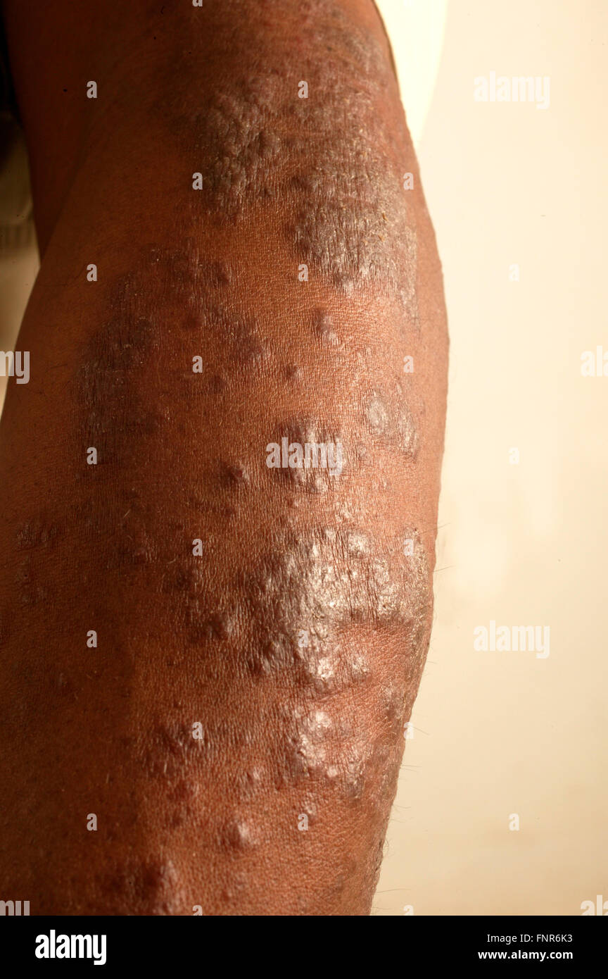 Braccio con uno sconosciuto lesione della pelle. Foto Stock