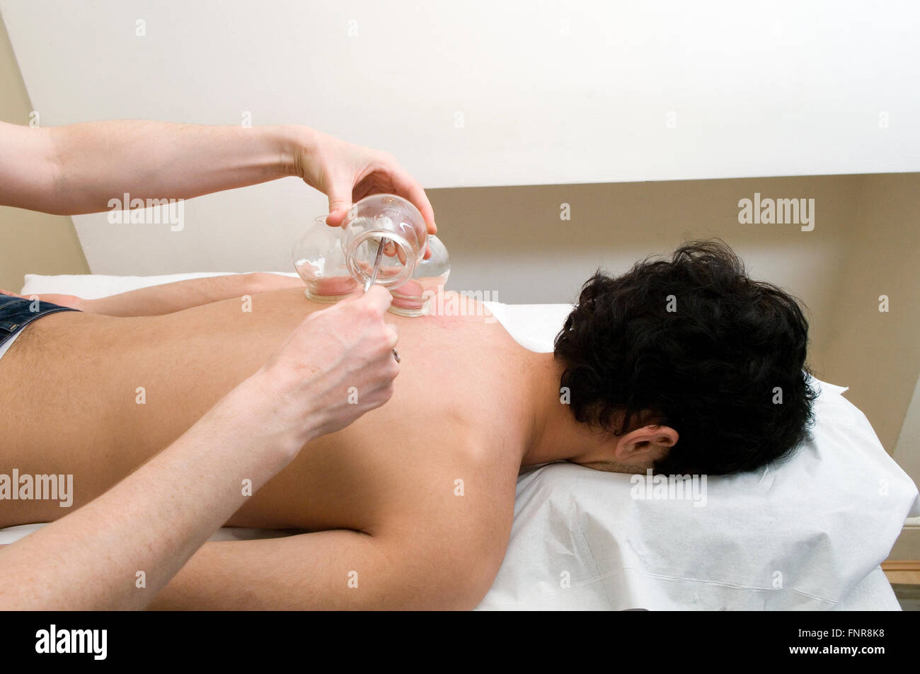 Agopuntura maschio paziente viene sottoposto ad imbutitura, una tecnica in cui una coppa di vetro viene aspirata sul corpo. Foto Stock