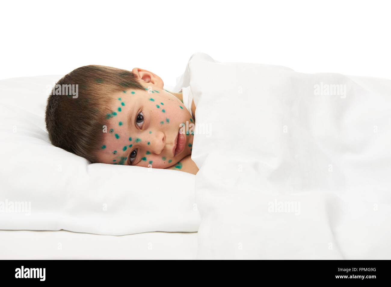 Bambino malato ha il virus sulla pelle Foto Stock