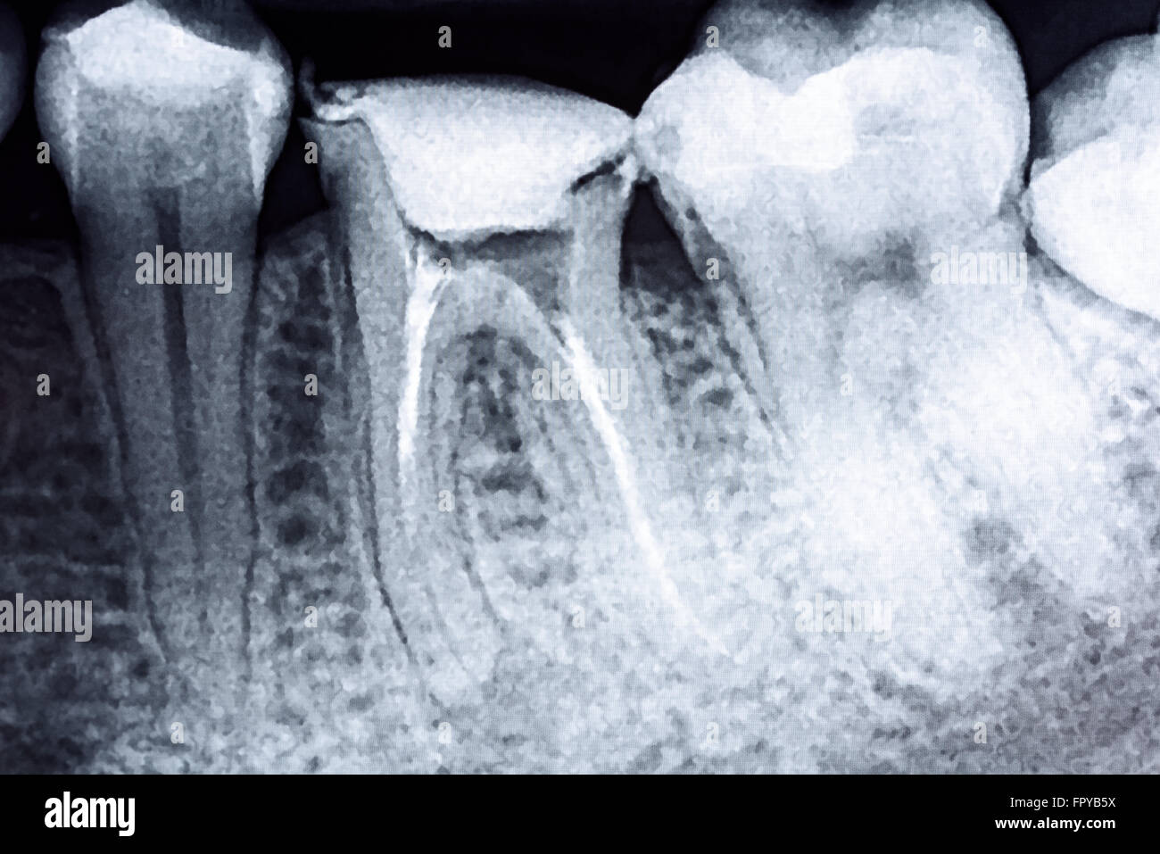 Scleroterapia completo del canale radicolare sistemi sui denti X-Ray Foto Stock