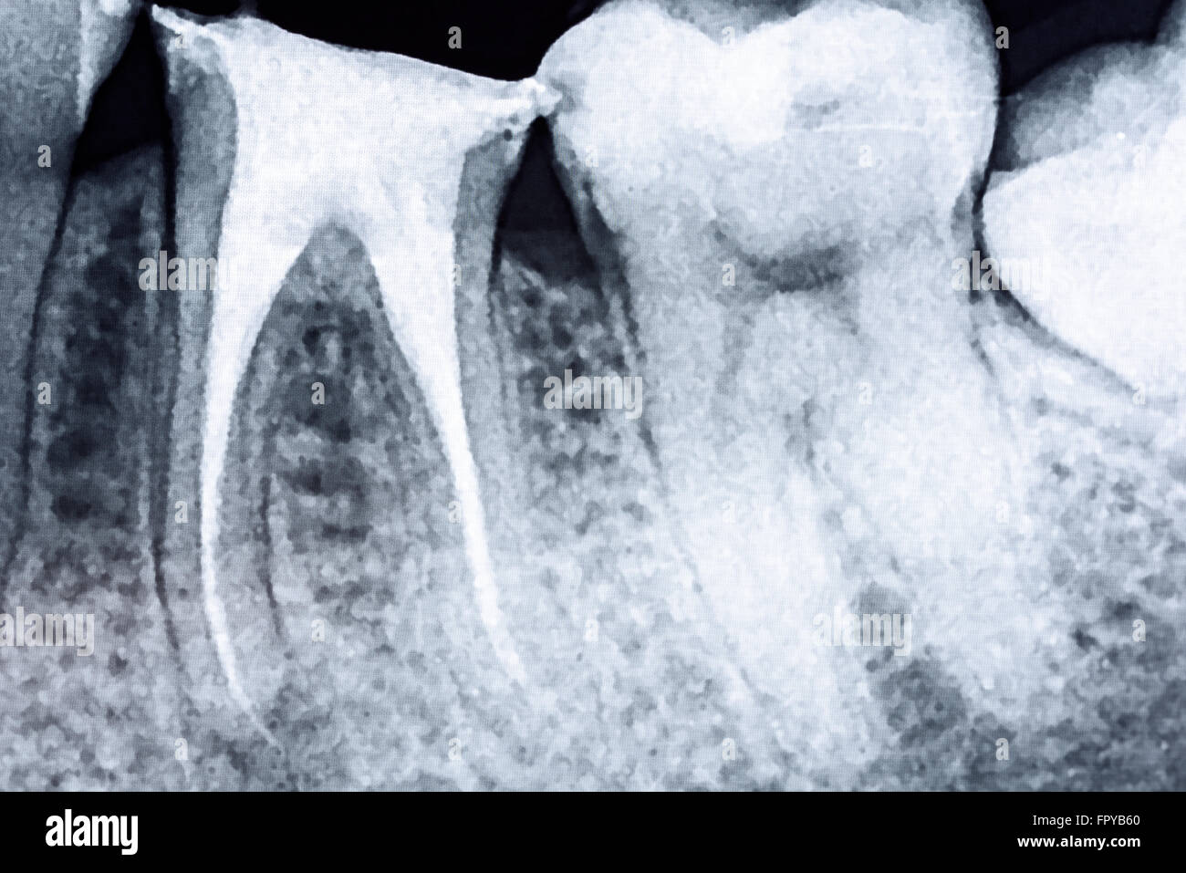 Scleroterapia completo del canale radicolare sistemi sui denti X-Ray Foto Stock